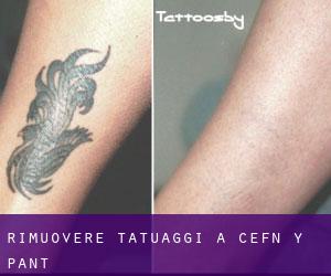 Rimuovere Tatuaggi a Cefn-y-pant
