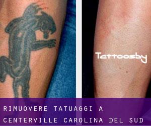 Rimuovere Tatuaggi a Centerville (Carolina del Sud)
