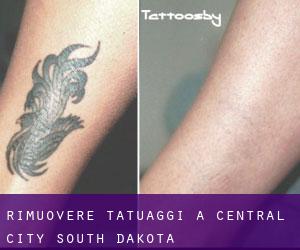 Rimuovere Tatuaggi a Central City (South Dakota)