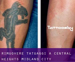 Rimuovere Tatuaggi a Central Heights-Midland City