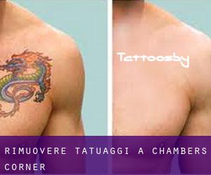 Rimuovere Tatuaggi a Chambers Corner