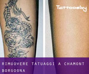 Rimuovere Tatuaggi a Chamont (Borgogna)
