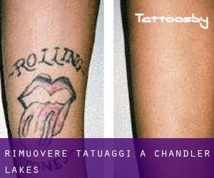 Rimuovere Tatuaggi a Chandler Lakes