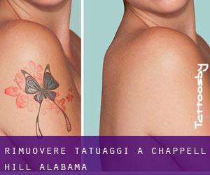 Rimuovere Tatuaggi a Chappell Hill (Alabama)