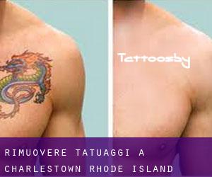 Rimuovere Tatuaggi a Charlestown (Rhode Island)