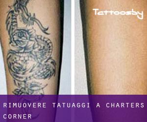 Rimuovere Tatuaggi a Charters Corner
