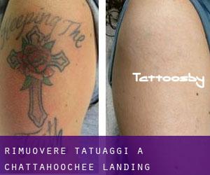 Rimuovere Tatuaggi a Chattahoochee Landing