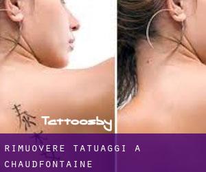 Rimuovere Tatuaggi a Chaudfontaine