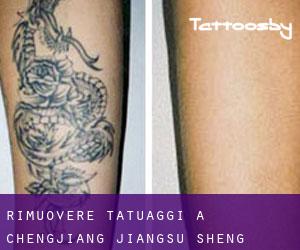Rimuovere Tatuaggi a Chengjiang (Jiangsu Sheng)
