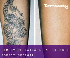 Rimuovere Tatuaggi a Cherokee Forest (Georgia)