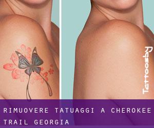 Rimuovere Tatuaggi a Cherokee Trail (Georgia)