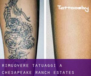 Rimuovere Tatuaggi a Chesapeake Ranch Estates