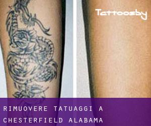 Rimuovere Tatuaggi a Chesterfield (Alabama)