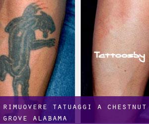 Rimuovere Tatuaggi a Chestnut Grove (Alabama)
