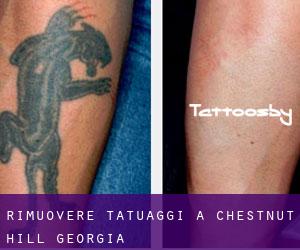 Rimuovere Tatuaggi a Chestnut Hill (Georgia)