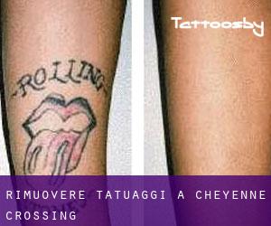 Rimuovere Tatuaggi a Cheyenne Crossing