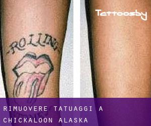 Rimuovere Tatuaggi a Chickaloon (Alaska)