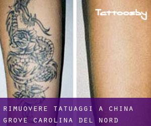 Rimuovere Tatuaggi a China Grove (Carolina del Nord)