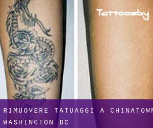 Rimuovere Tatuaggi a Chinatown (Washington, D.C.)