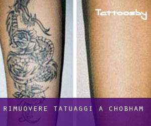Rimuovere Tatuaggi a Chobham