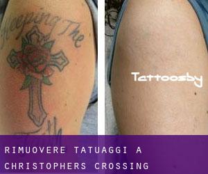 Rimuovere Tatuaggi a Christophers Crossing