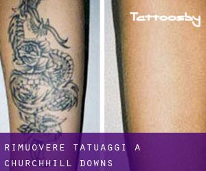 Rimuovere Tatuaggi a Churchhill Downs