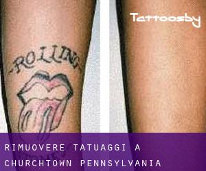 Rimuovere Tatuaggi a Churchtown (Pennsylvania)