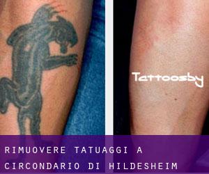 Rimuovere Tatuaggi a Circondario di Hildesheim