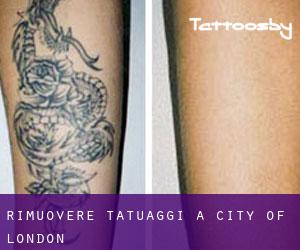 Rimuovere Tatuaggi a City of London