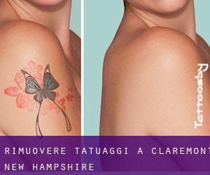Rimuovere Tatuaggi a Claremont (New Hampshire)