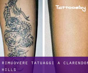 Rimuovere Tatuaggi a Clarendon Hills