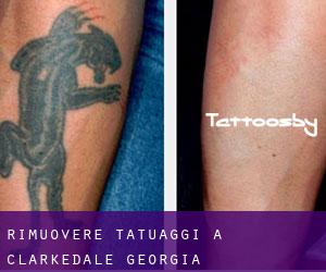 Rimuovere Tatuaggi a Clarkedale (Georgia)