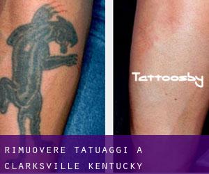 Rimuovere Tatuaggi a Clarksville (Kentucky)