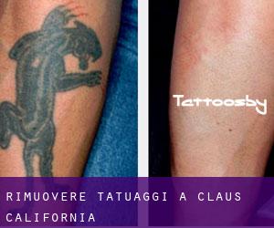 Rimuovere Tatuaggi a Claus (California)