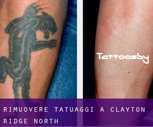 Rimuovere Tatuaggi a Clayton Ridge North