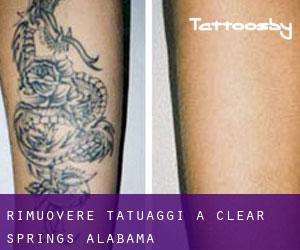 Rimuovere Tatuaggi a Clear Springs (Alabama)