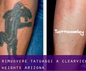 Rimuovere Tatuaggi a Clearview Heights (Arizona)