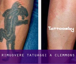Rimuovere Tatuaggi a Clemmons