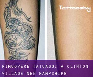 Rimuovere Tatuaggi a Clinton Village (New Hampshire)