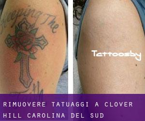 Rimuovere Tatuaggi a Clover Hill (Carolina del Sud)