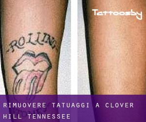 Rimuovere Tatuaggi a Clover Hill (Tennessee)