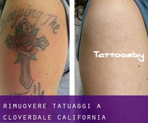 Rimuovere Tatuaggi a Cloverdale (California)