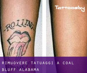 Rimuovere Tatuaggi a Coal Bluff (Alabama)