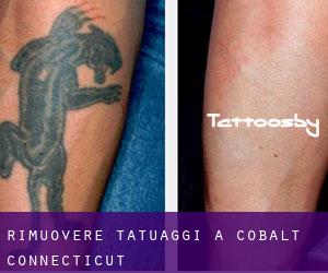 Rimuovere Tatuaggi a Cobalt (Connecticut)