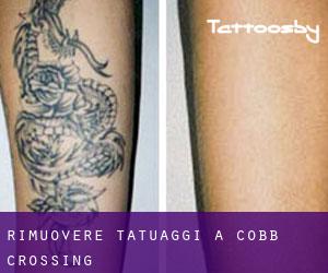 Rimuovere Tatuaggi a Cobb Crossing