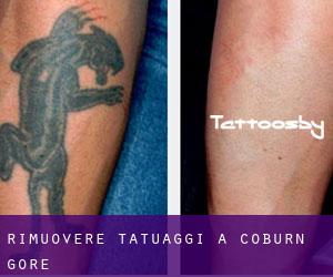 Rimuovere Tatuaggi a Coburn Gore