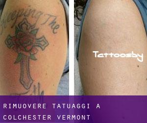 Rimuovere Tatuaggi a Colchester (Vermont)