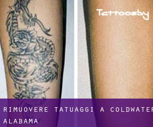 Rimuovere Tatuaggi a Coldwater (Alabama)