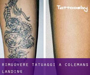 Rimuovere Tatuaggi a Colemans Landing