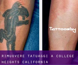 Rimuovere Tatuaggi a College Heights (California)